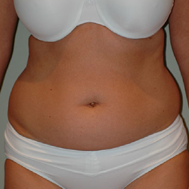 Choosing A Tummy Tuck After Pregnancy, Reversing The Physical
