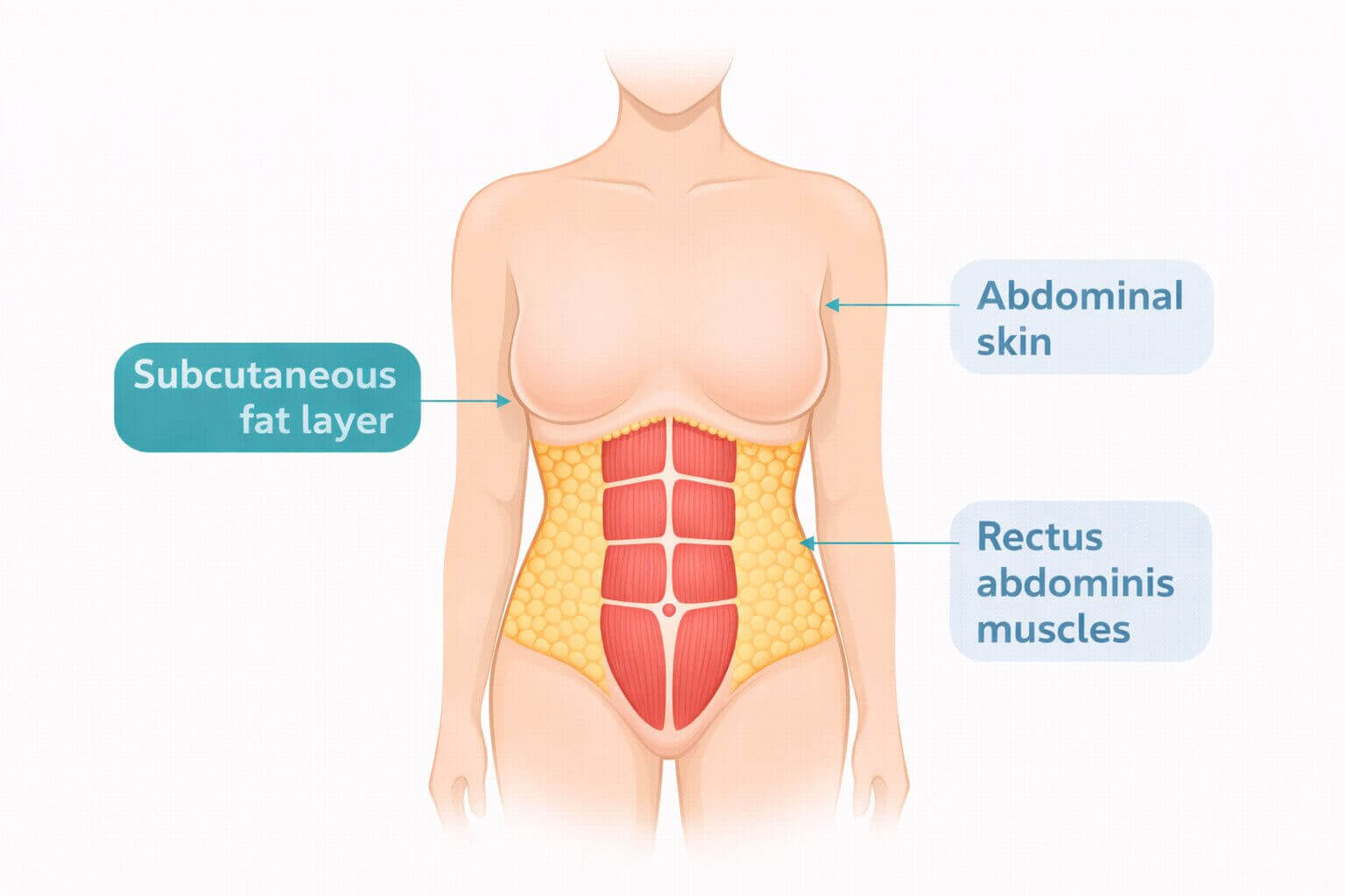 Anatomical diagram showing three layers of the female abdomen including subcutaneous fat, skin, and rectus abdominis muscles