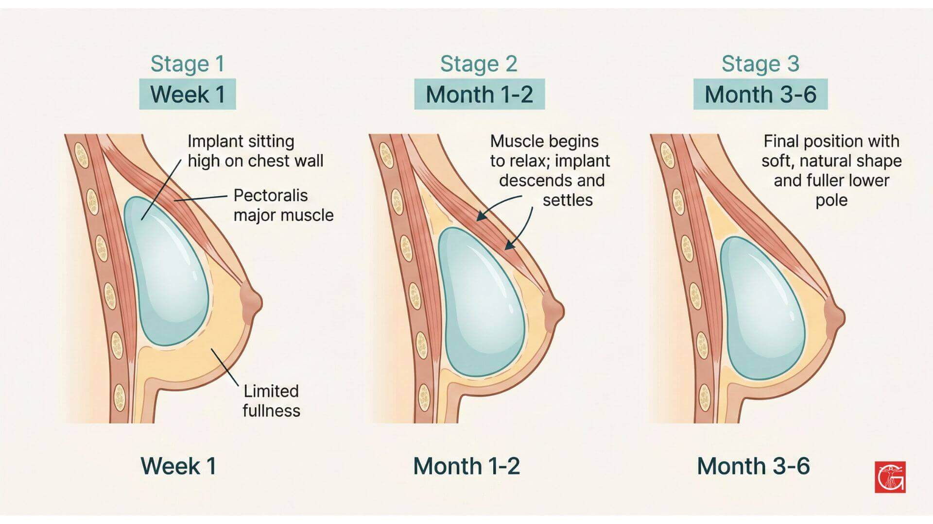 Drop and fluff timeline diagram showing how breast implants settle from a high position into a natural shape over three to six months after augmentation