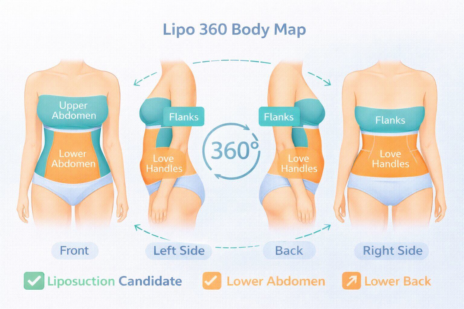 360-degree body map infographic showing Lipo 360 treatment areas on the abdomen, flanks, love handles, and lower back from front, side, and back views