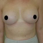 Breast Augmentation Before & After Patient #356