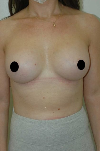 Breast Augmentation Before & After Patient #356