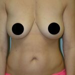 Awake Breast Augmentation Before & After Patient #1337