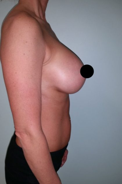 Awake Breast Augmentation Before & After Patient #1337