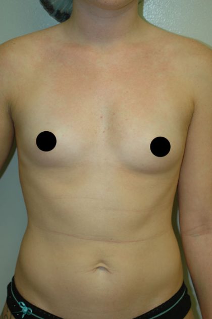 Awake Breast Augmentation Before & After Patient #1338