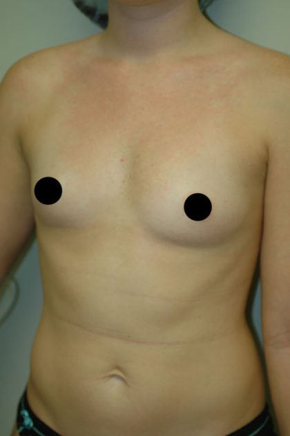 Awake Breast Augmentation Before & After Patient #1338
