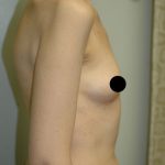 Awake Breast Augmentation Before & After Patient #1339
