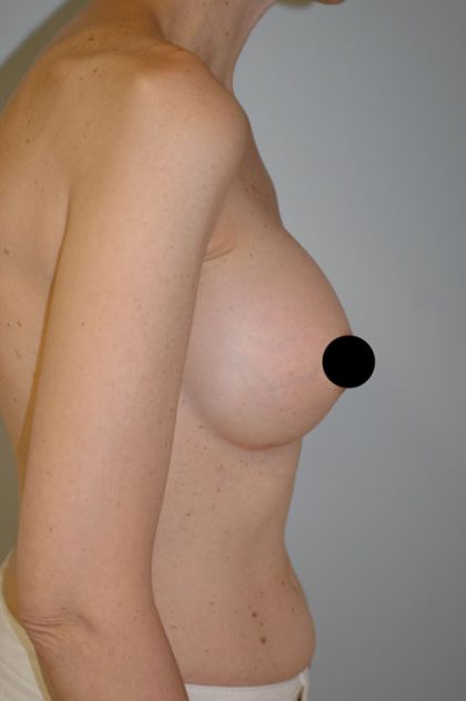 Awake Breast Augmentation Before & After Patient #1339