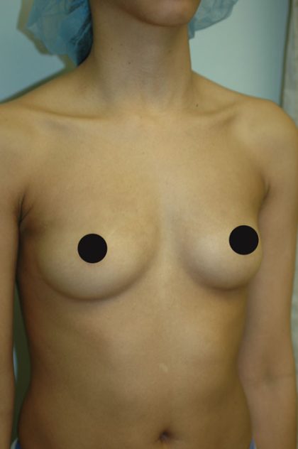 Awake Breast Augmentation Before & After Patient #1329