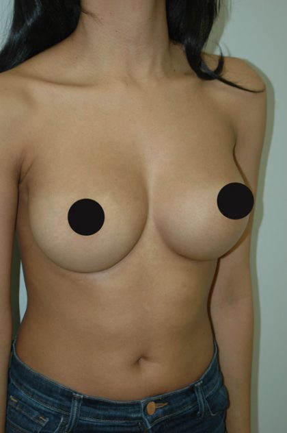 Awake Breast Augmentation Before & After Patient #1329