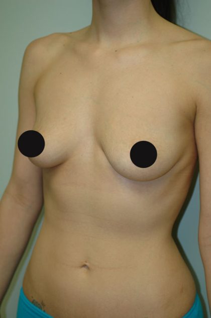 Awake Breast Augmentation Before & After Patient #1330