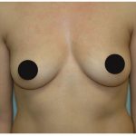 Awake Breast Augmentation Before & After Patient #1331