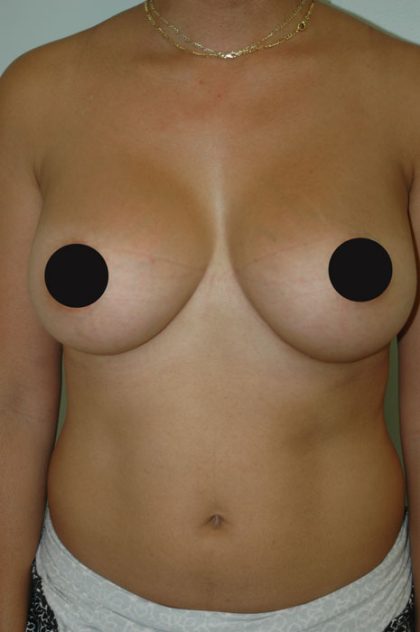 Awake Breast Augmentation Before & After Patient #1331
