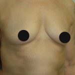 Awake Breast Augmentation Before & After Patient #1332