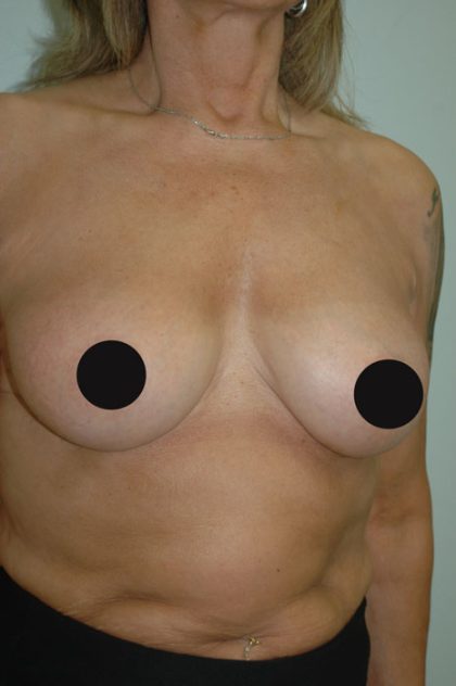 Awake Breast Augmentation Before & After Patient #1332