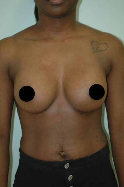 Awake Breast Augmentation Before & After Patient #1333