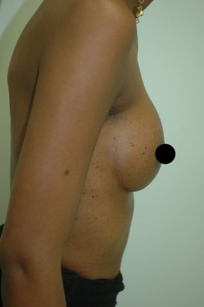 Awake Breast Augmentation Before & After Patient #1333