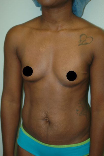 Awake Breast Augmentation Before & After Patient #1334