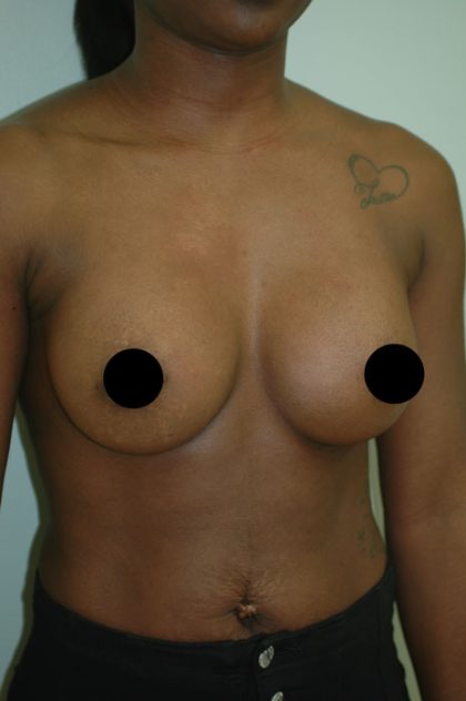Awake Breast Augmentation Before & After Patient #1334