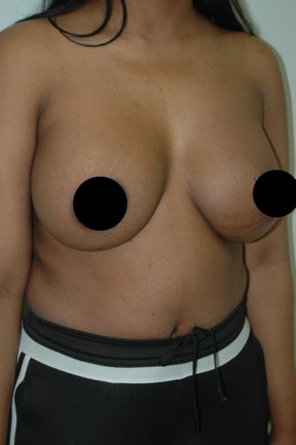 Awake Breast Augmentation Before & After Patient #1335