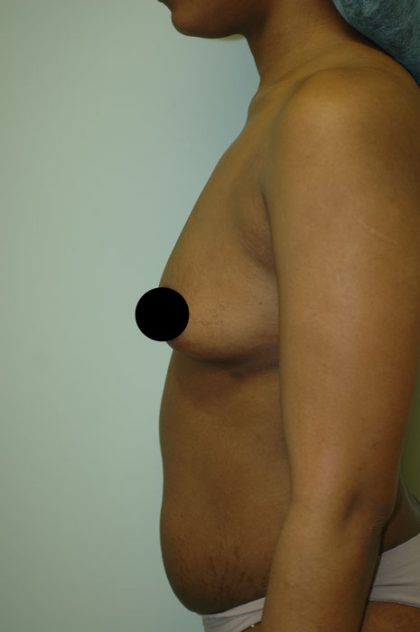 Awake Breast Augmentation Before & After Patient #1335