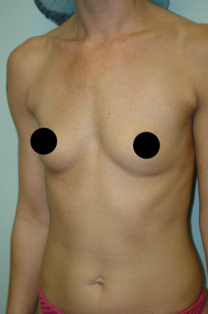Awake Breast Augmentation Before & After Patient #1336