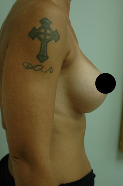 Awake Breast Augmentation Before & After Patient #1336