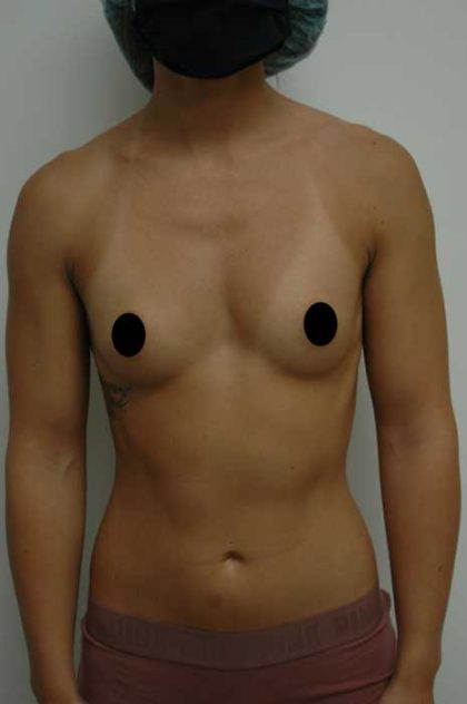 Breast Augmentation Before & After Patient #1004