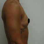 Breast Augmentation Before & After Patient #1004