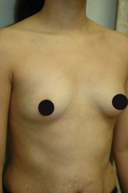 Breast Augmentation Before & After Patient #995