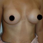 Breast Augmentation Before & After Patient #995