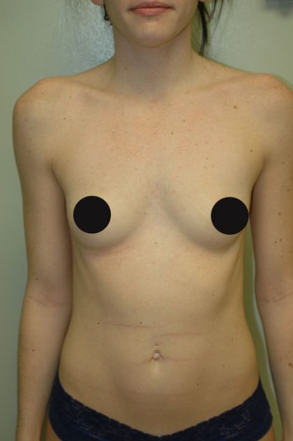 Breast Augmentation Before & After Patient #994