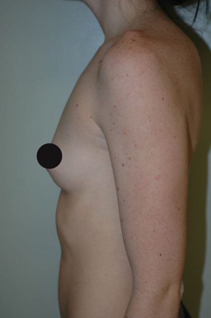 Breast Augmentation Before & After Patient #994