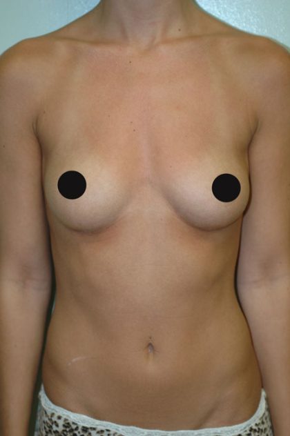 Breast Augmentation Before & After Patient #993