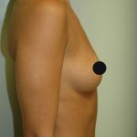 Breast Augmentation Before & After Patient #993