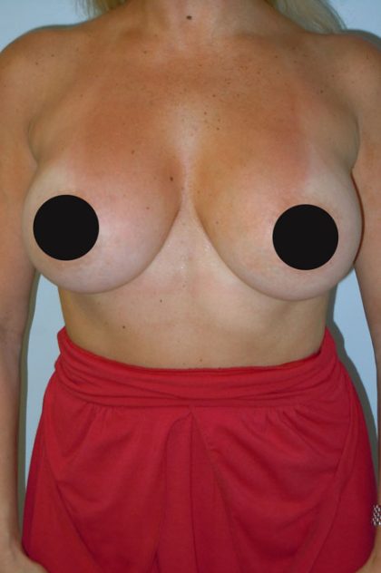 Breast Augmentation Before & After Patient #992