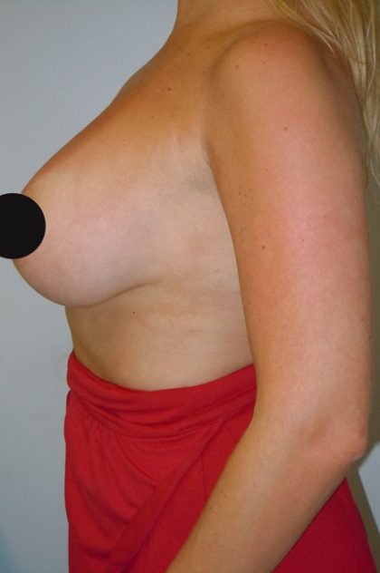 Breast Augmentation Before & After Patient #992