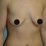 Breast Augmentation Before & After Patient #991