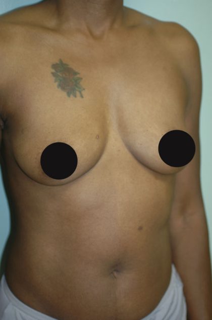 Breast Augmentation Before & After Patient #990
