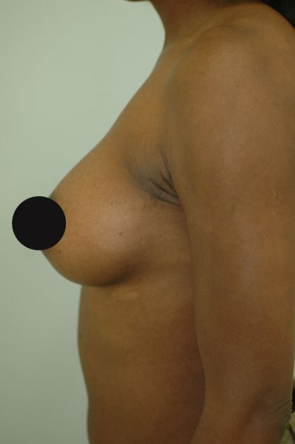 Breast Augmentation Before & After Patient #990