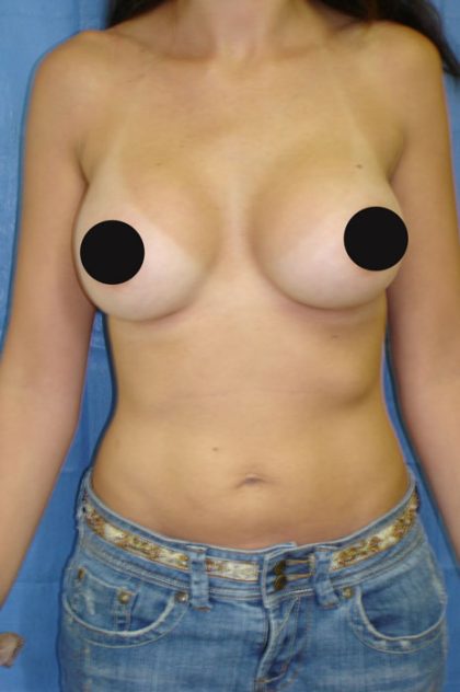 Breast Augmentation Before & After Patient #989