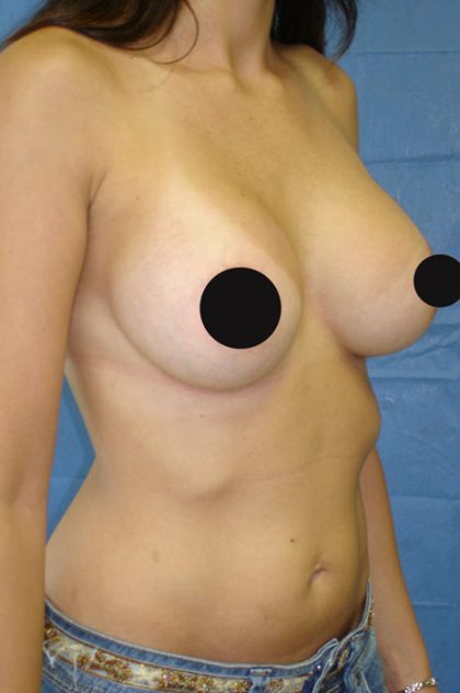 Breast Augmentation Before & After Patient #989
