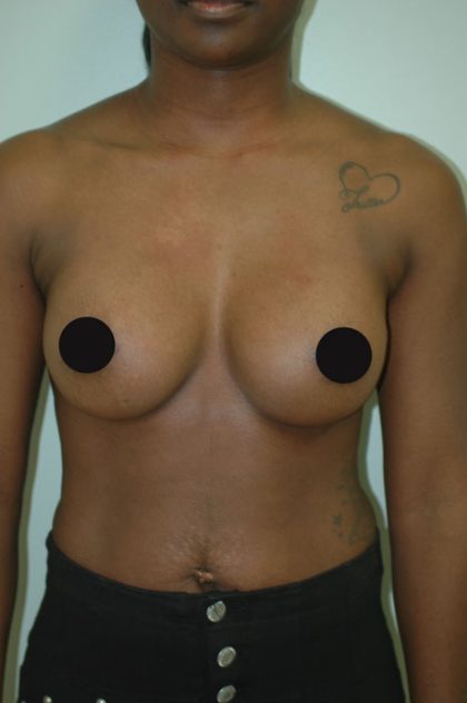 Breast Augmentation Before & After Patient #988