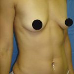 Breast Augmentation Before & After Patient #987