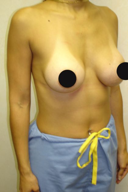 Breast Augmentation Before & After Patient #987