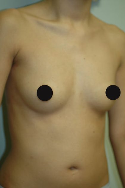Breast Augmentation Before & After Patient #986