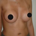 Breast Augmentation Before & After Patient #986