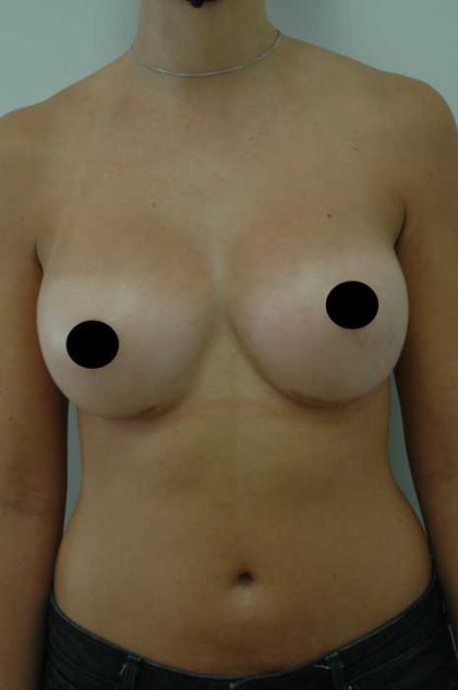 Breast Augmentation Before & After Patient #1003