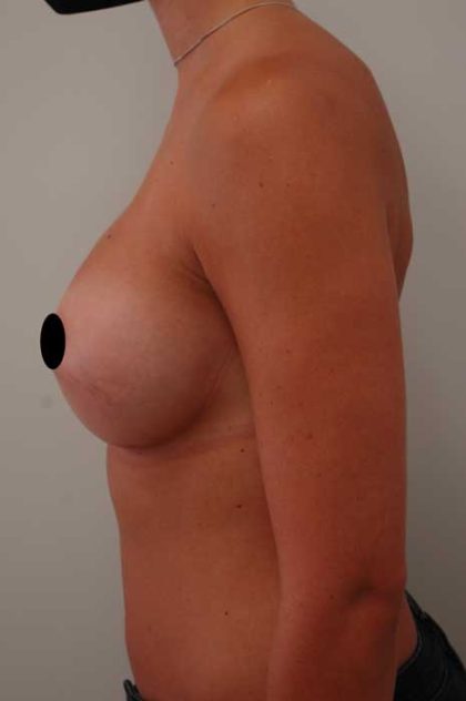 Breast Augmentation Before & After Patient #1003