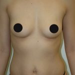 Breast Augmentation Before & After Patient #985